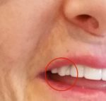 tooth-damage